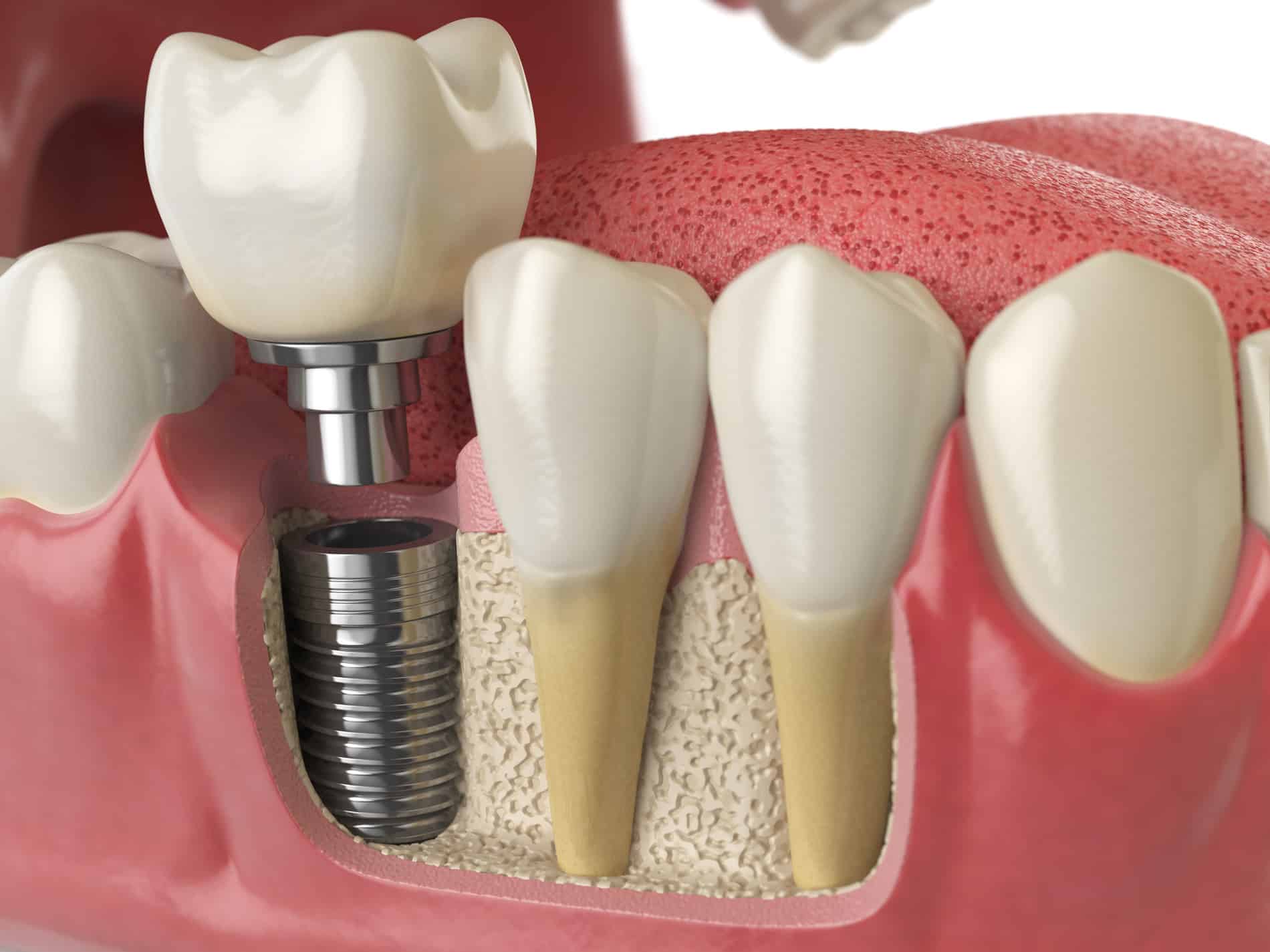 Dental Implants at Bear Canyon Dental in Nephi UT