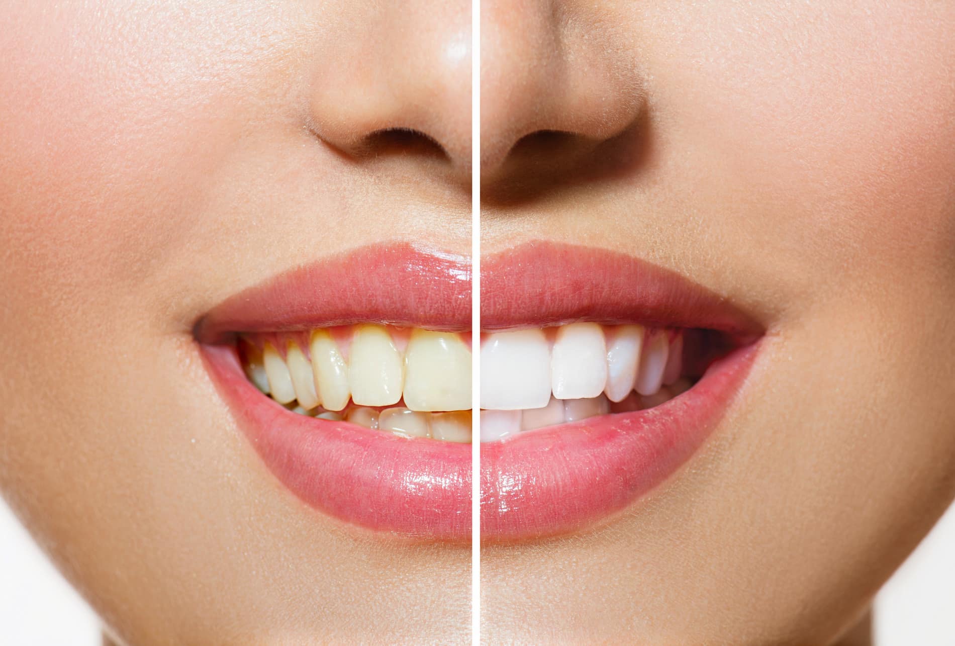 Woman's smile tranformation with teeth whitening services in Nephi UT