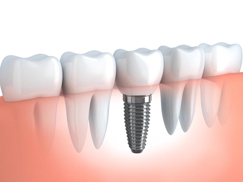 Dental Implants Nephi, UT