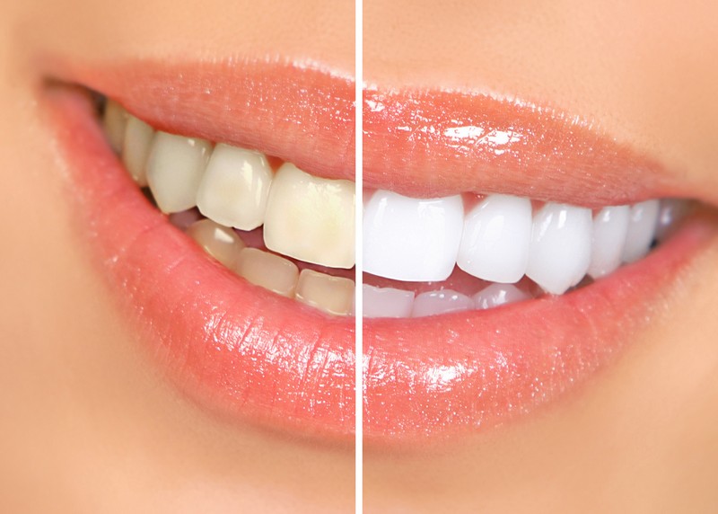 teeth whitening services Nephi, UT